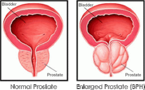 pro_prostate